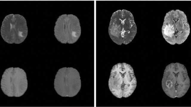 Bilden bestär av två delar: Fyra snittbilder av en hjärna på ena sidan och fyra snittbilder av en annan hjärna på andra sidan