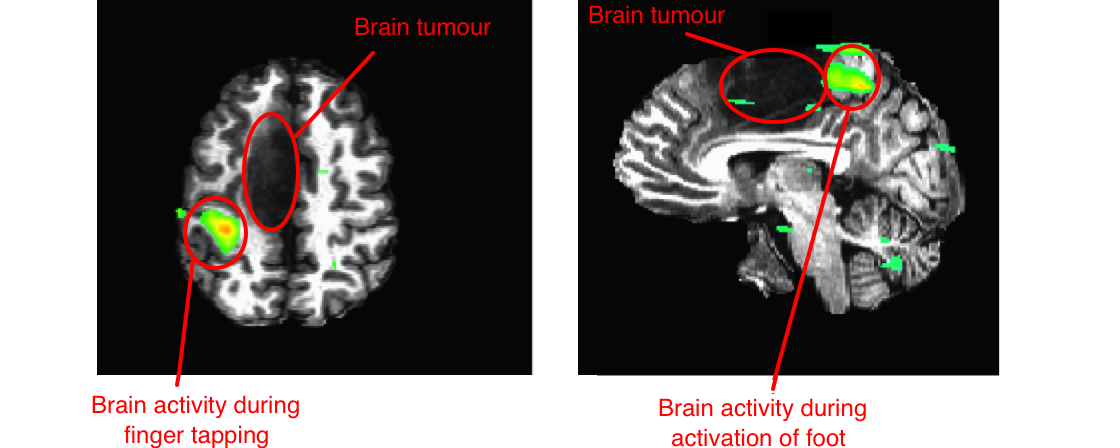fMRI tumour