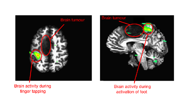 fMRI tumour