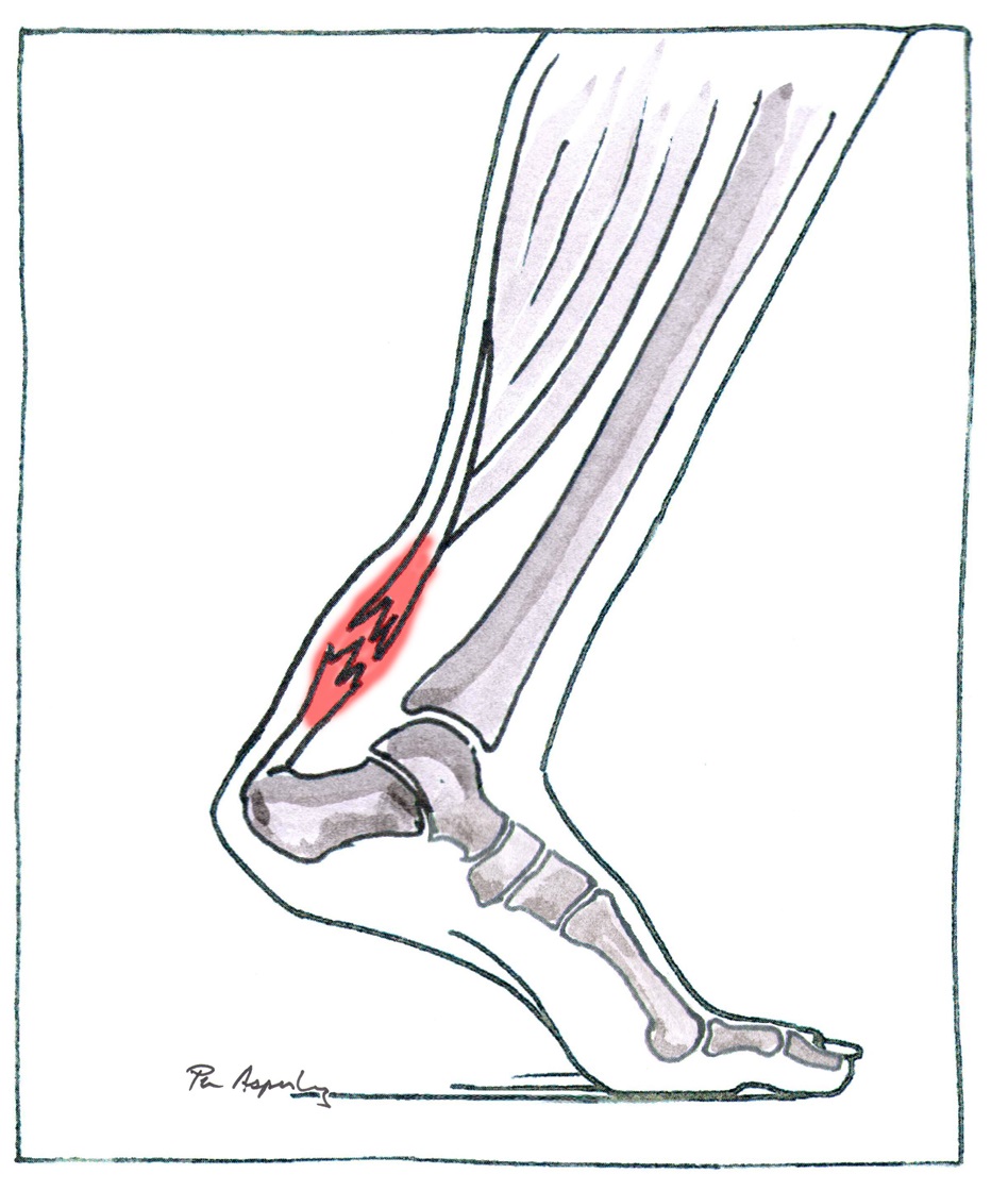 Drawing of a damaged Achilles tendon with inflammation.