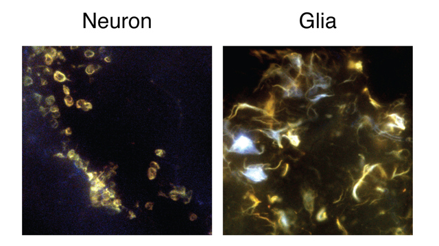 microscopy image of amyloid plaques in yellow and blue