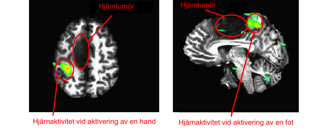 fMRI-tumör