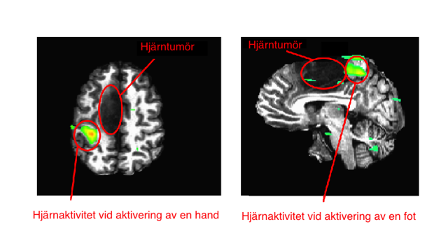 fMRI-tumör