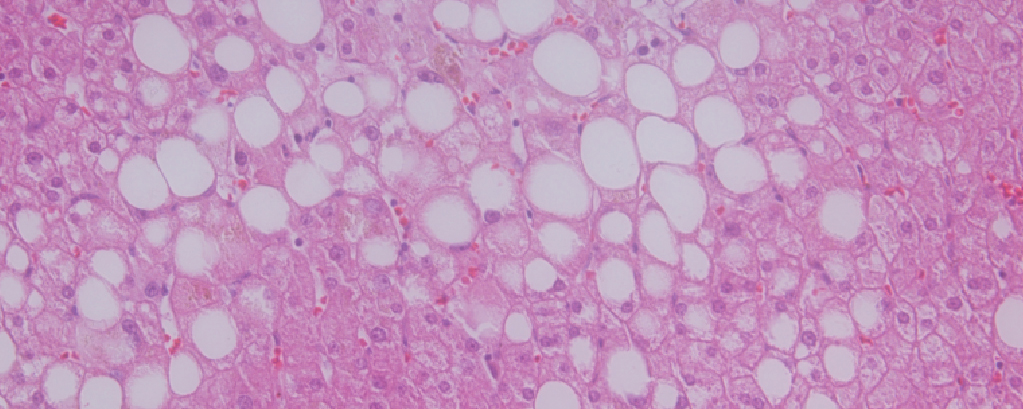 Microscopy image of liver. White areas represent accumulated fat.