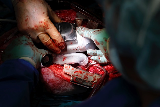 Implantering av artificiell hjärtpump i gris. Scandinavian Real Heart 11.