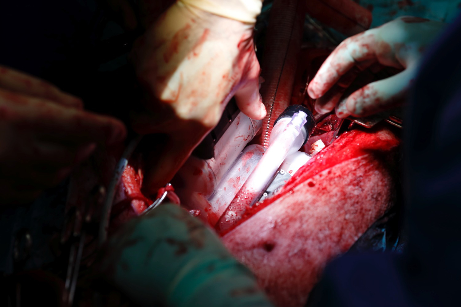 Implantering av artificiell hjärtpump i gris. Scandinavian Real Heart 11.
