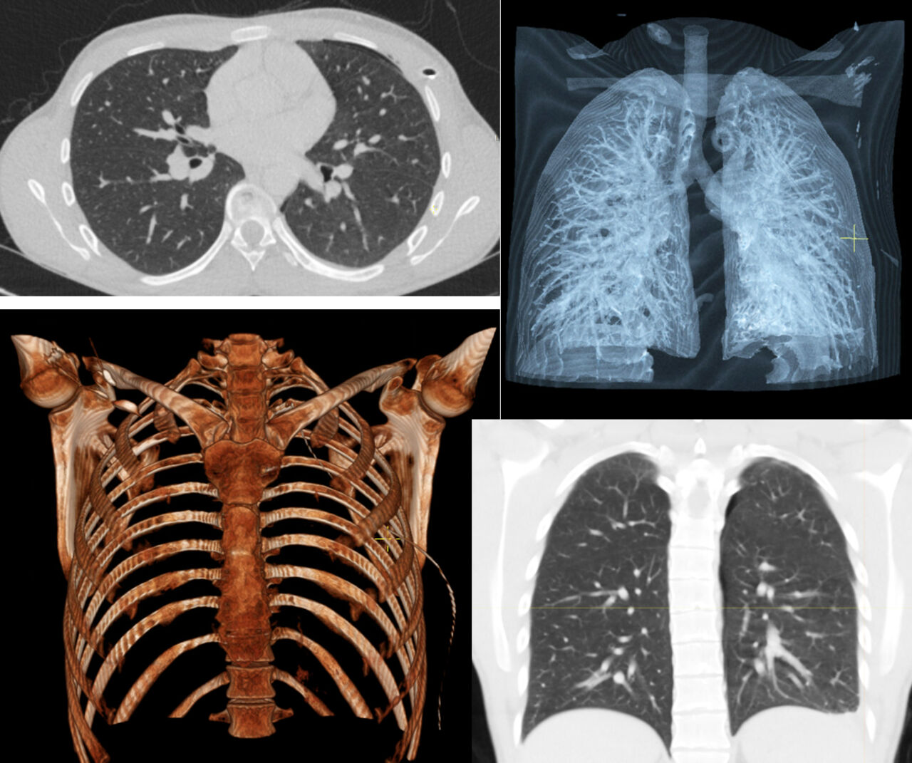 Röntgenbilder på lungor