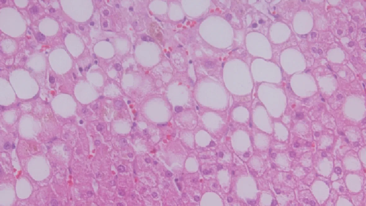 Bild på utsnitt av fettlever