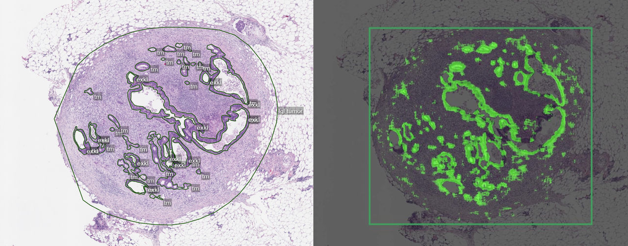 interaktivt verktyg som kan assistera vid diagnos av misstänkta tumörer i lymfsystemet