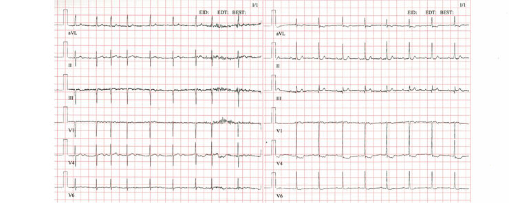 EKG-kurva med förmaksflimmer respektive sinusrytm