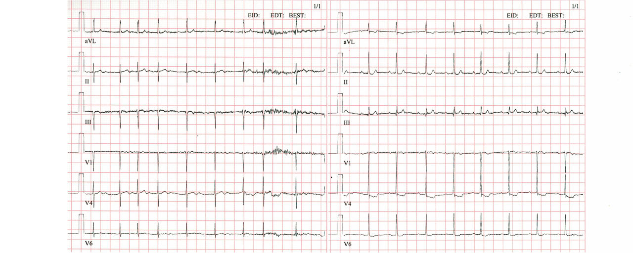 ECG curve with atrial fibrillation and sinus rhythm, respectively