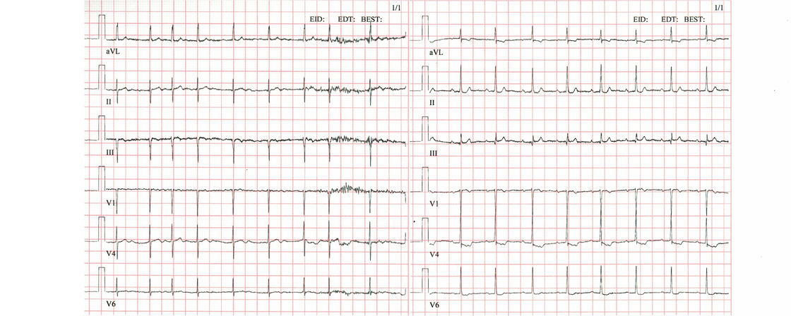 ECG curve with atrial fibrillation and sinus rhythm, respectively