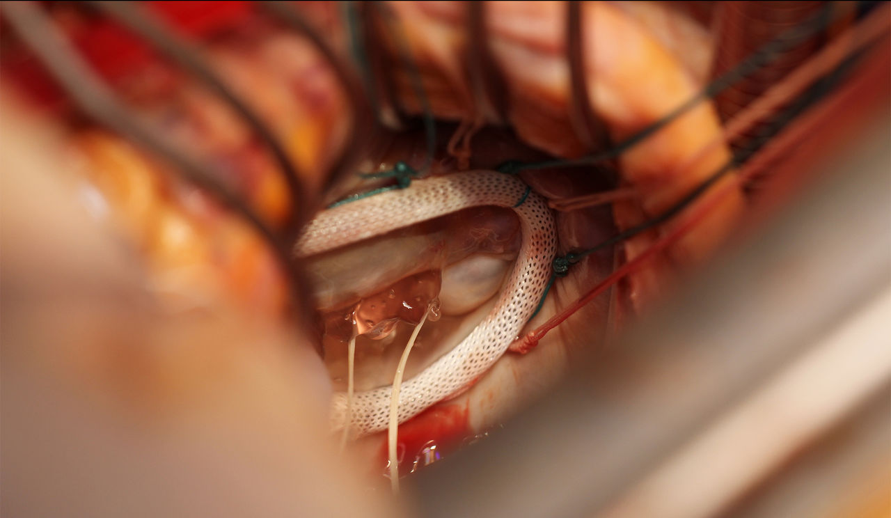 Mitral valve surgery