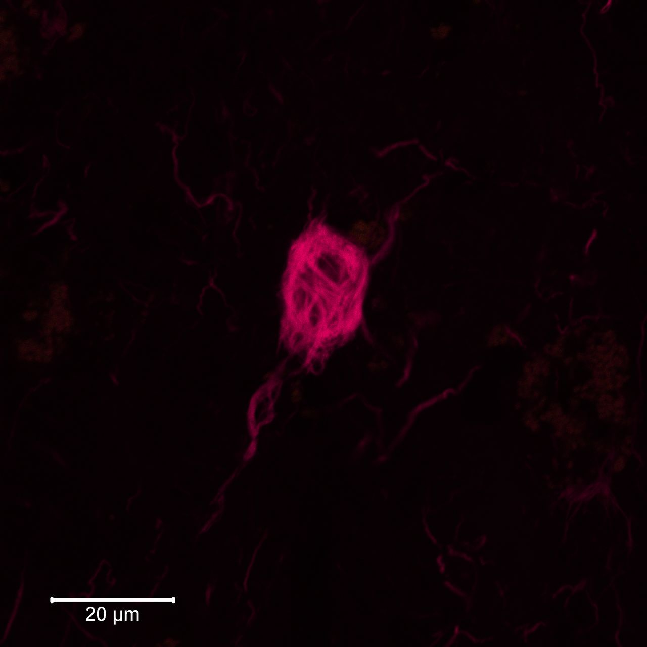 Tau-aggregat inuti nervceller i hjärnvävnad, som färgats in med LiU-forskarnas spårarmolekyler.