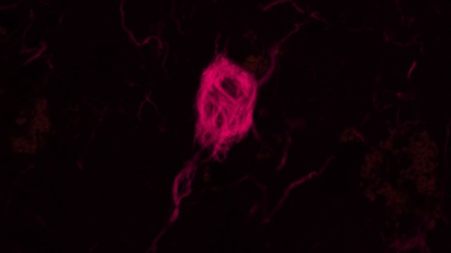Microscopy image showing tau aggregates inside a neuron