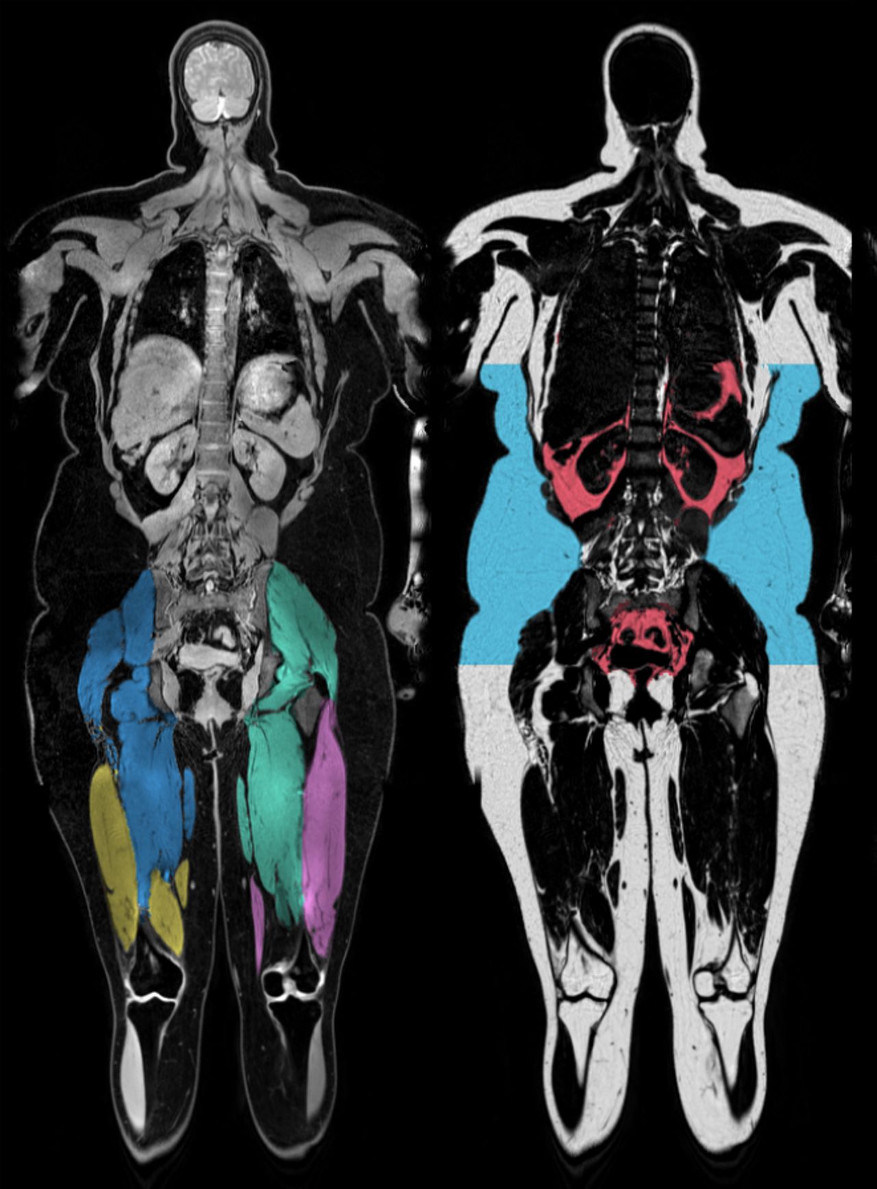 Body fat distribution