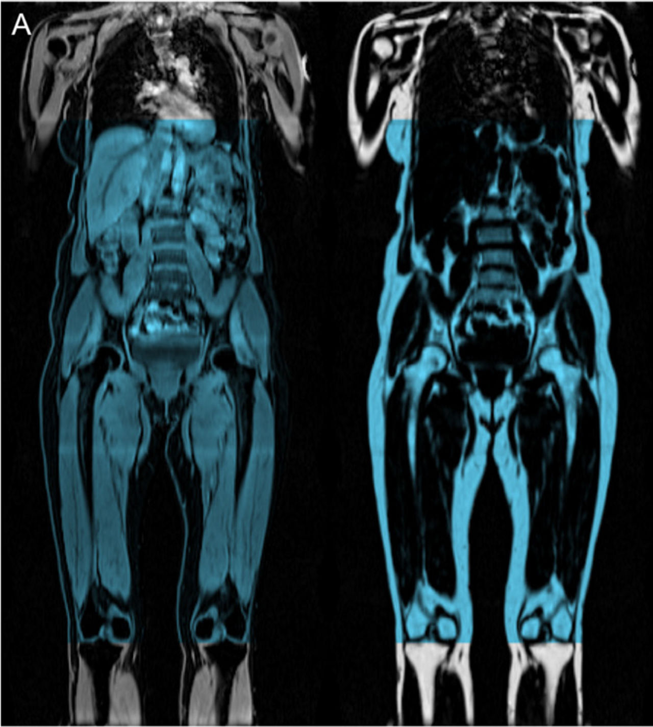 MRI scan body