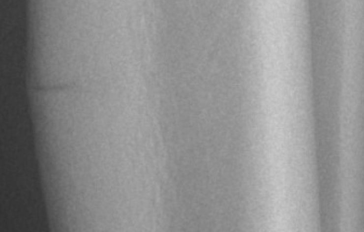 Stress fracture on X-ray.
