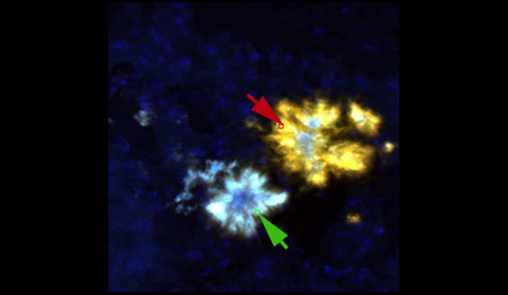 Microscope image showing wellow and blue staining of irregular shapes.