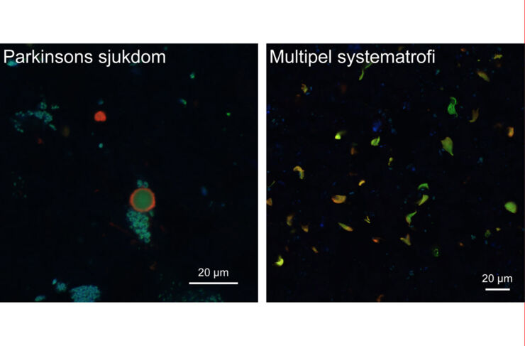 Aggregat av alfa-synuklein i celler i mänsklig hjärnvävnad som färgats in med spårarmolekyl (grön) och antikropp mot alfa-synuklein (röd). Den turkosa eller blå färgen kommer av ett annat ämne (lipofuscin) som ansamlas i åldrande hjärnceller, men som inte har någon betydelse för studiernas resultat.