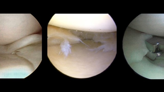 Arthroscopy images of meniscus damages
