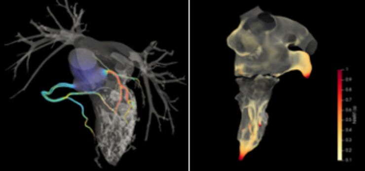 CT-bilder av hjärtat som visar flöda i kranskärl och hela hjärtat