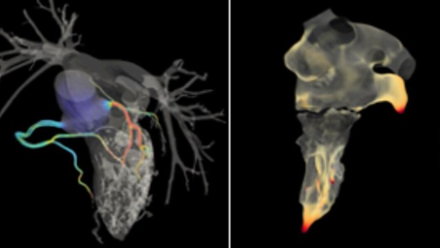 CT-bilder av hjärtat som visar flöda i kranskärl och hela hjärtat