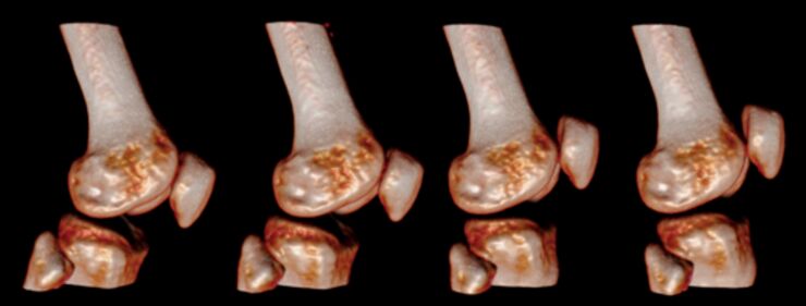 CT-bild av knäleden i olika lägen.