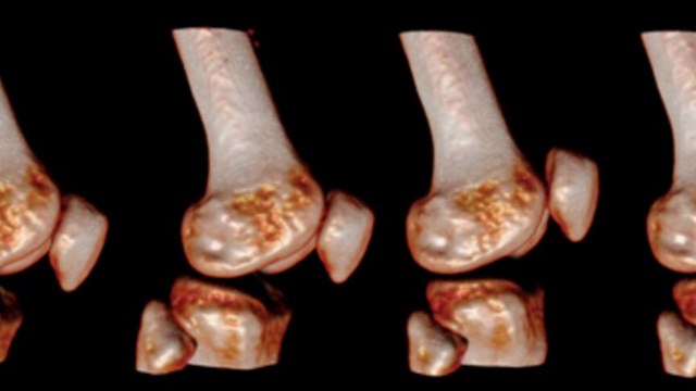 CT-bild av knäleden i olika lägen.