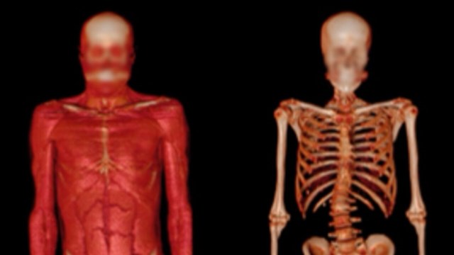 CT-bild av överkropp som visar muskler respektive skelett