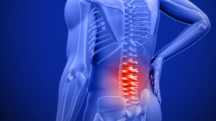 Blåtonad grafikbild som visar ryggen på en människa. Skelettet syns och det är rött runt ländryggen.