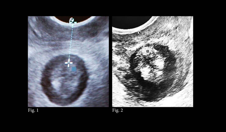 Ultrasound images of anal sphincter and perineal region. 