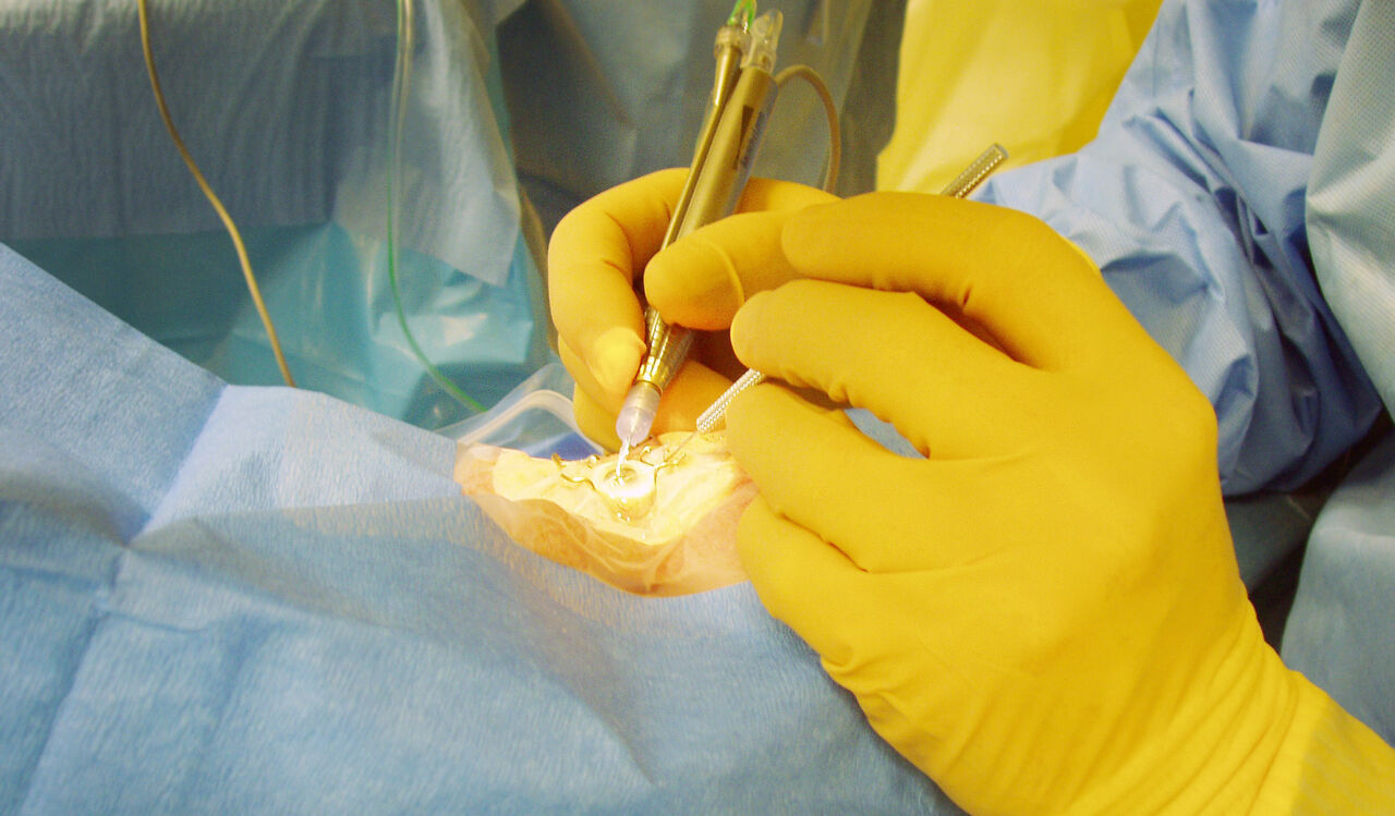 Bild på operation av gråstarr.