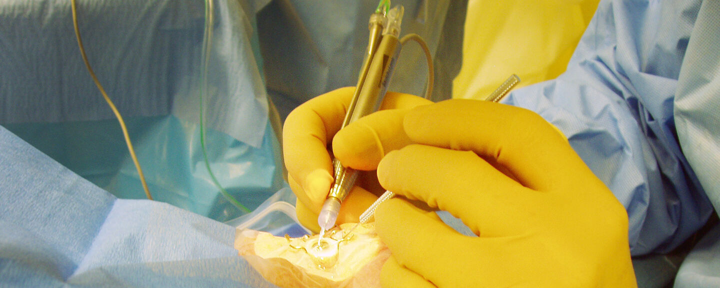 Photo of cataract operation.