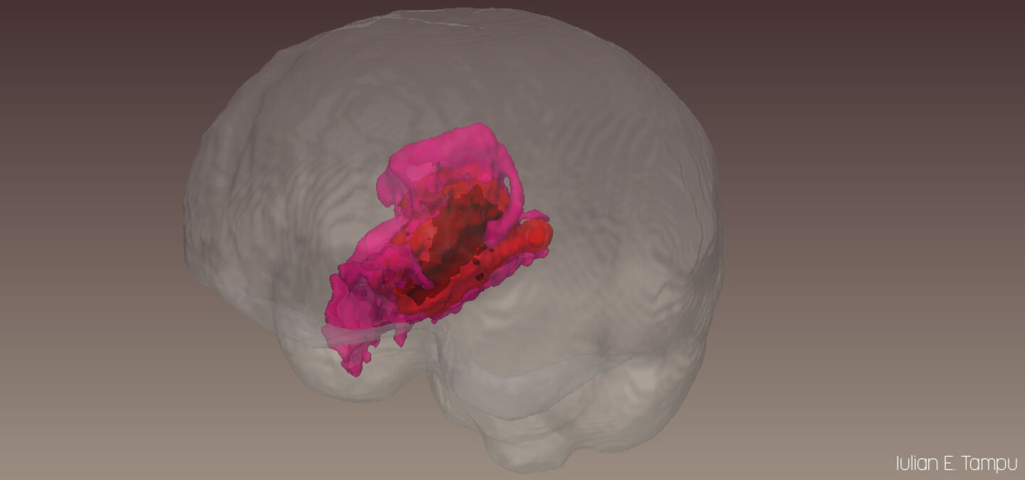 En bild på en hjärna i 3D. Hjärnan är genomskinlig förutom en del som är lila.