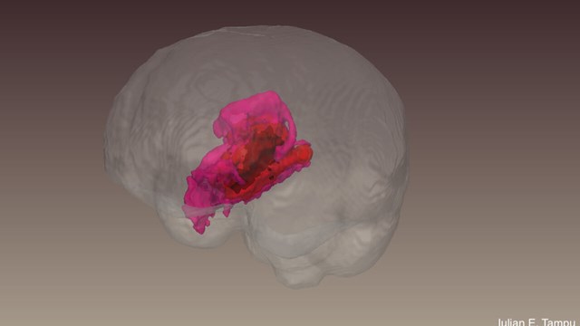 En bild på en hjärna i 3D. Hjärnan är genomskinlig förutom en del som är lila.