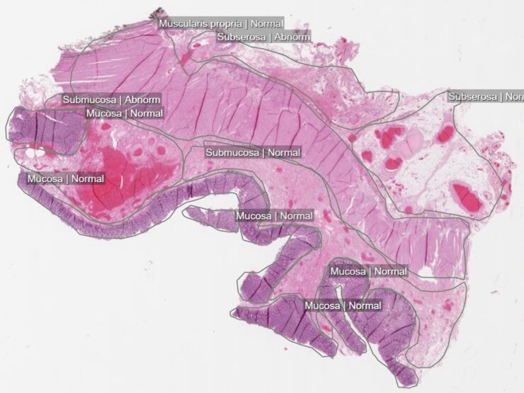 Digital image of a tissue sample of colon cancer from the BIGPICTURE predecessor AIDA Data Hub. For AI training purposes, tumour cells and other components have been labeled by an expert