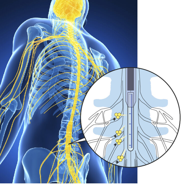 Grafik som visar en jonpump implanterad i en människas ryggrad