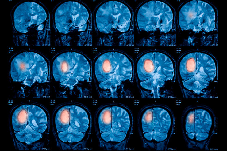 MR-bild på en mänsklig hjärna med en tumör.