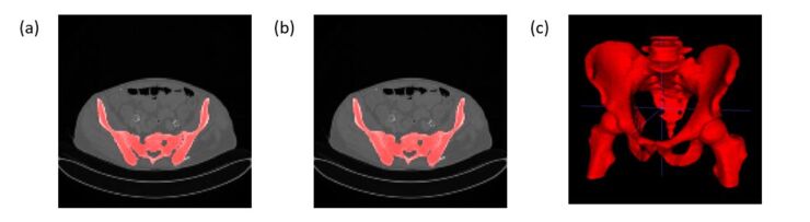 Three x-ray pictures of a pelvis.