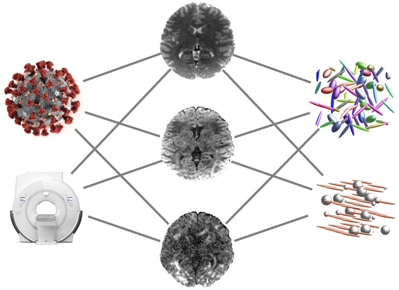 Photo with MRI of a human brain and a closeup of a covid-19 virus. The background is white.