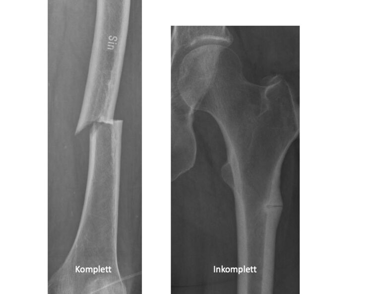 image of incomplete atypical fracture next to a complete fracture.