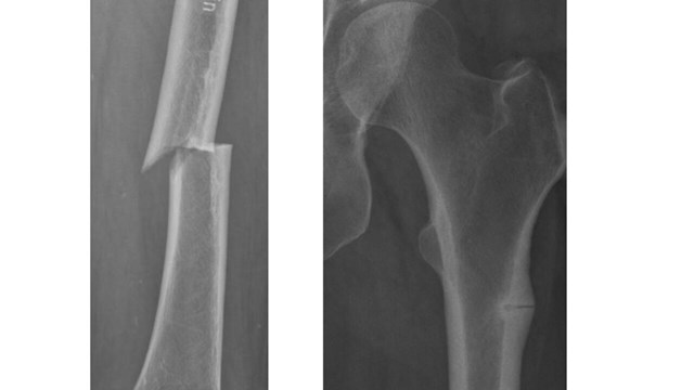 image of incomplete atypical fracture next to a complete fracture.