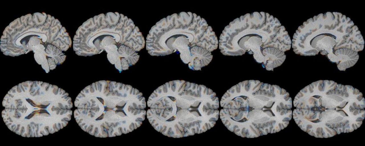Synthetic slices of an MRI 3D volume, from a generative adversarial network (GAN). The intermediate slices have been generated by an interpolating between the leftmost and rightmost slices, in the learned GAN latent representation space. These represent initial results of techniques for composing synthetic 3D volumes.