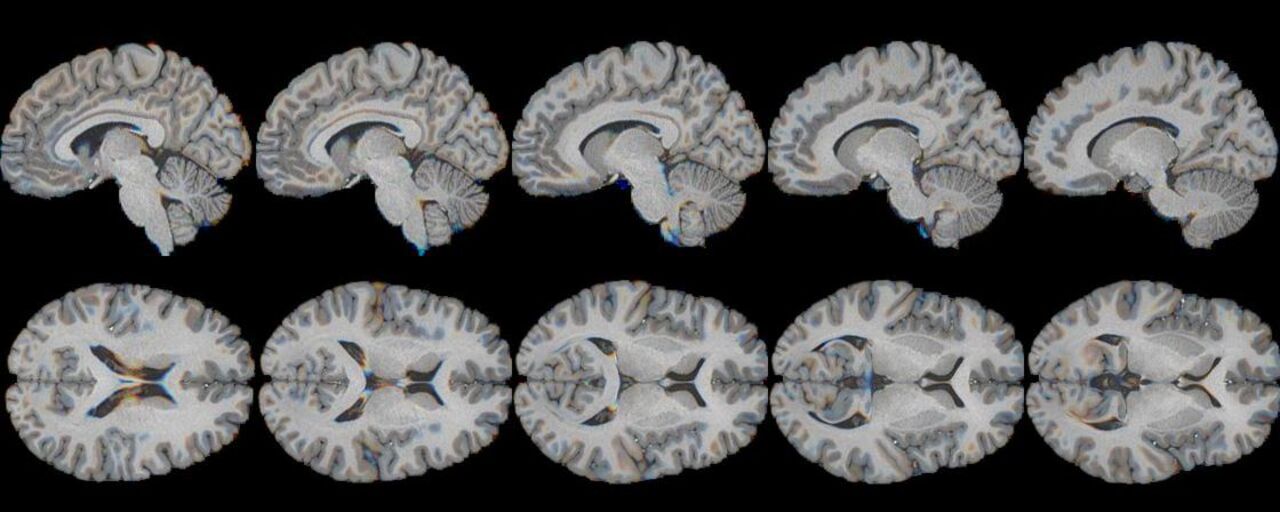 Syntetiska bilder av en MRI 3D-volym, från ett generative adversarial network (GAN). De mellanliggande bilderna har genererats med en interpolering mellan bilderna längst till vänster och höger, i den inlärda latenta representationen i ett GAN. Dessa representerar initiala resultat av tekniker för att komponera syntetiska 3D-volymer.