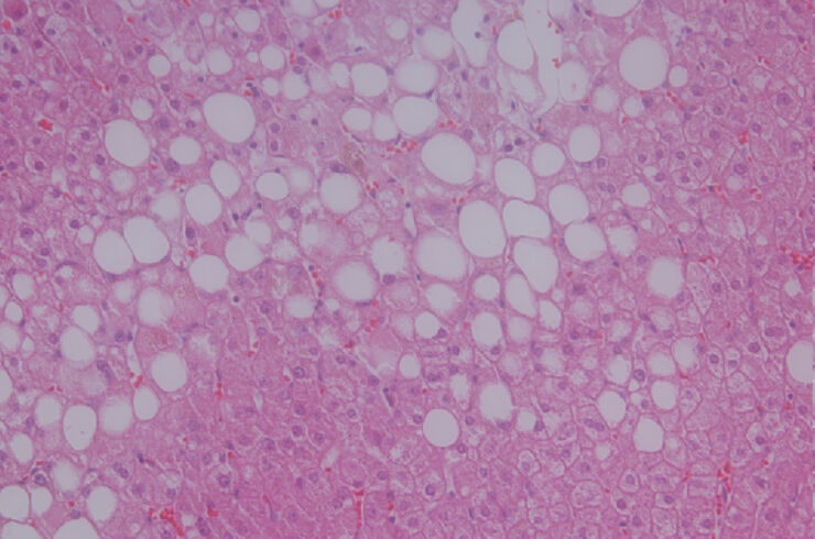 Microscopy image of fat in the liver. 
