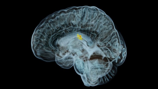 MR scan of tumor in a human brain