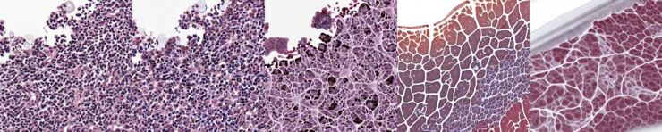 A digital pathology patch transformed by a generative diffusion model
