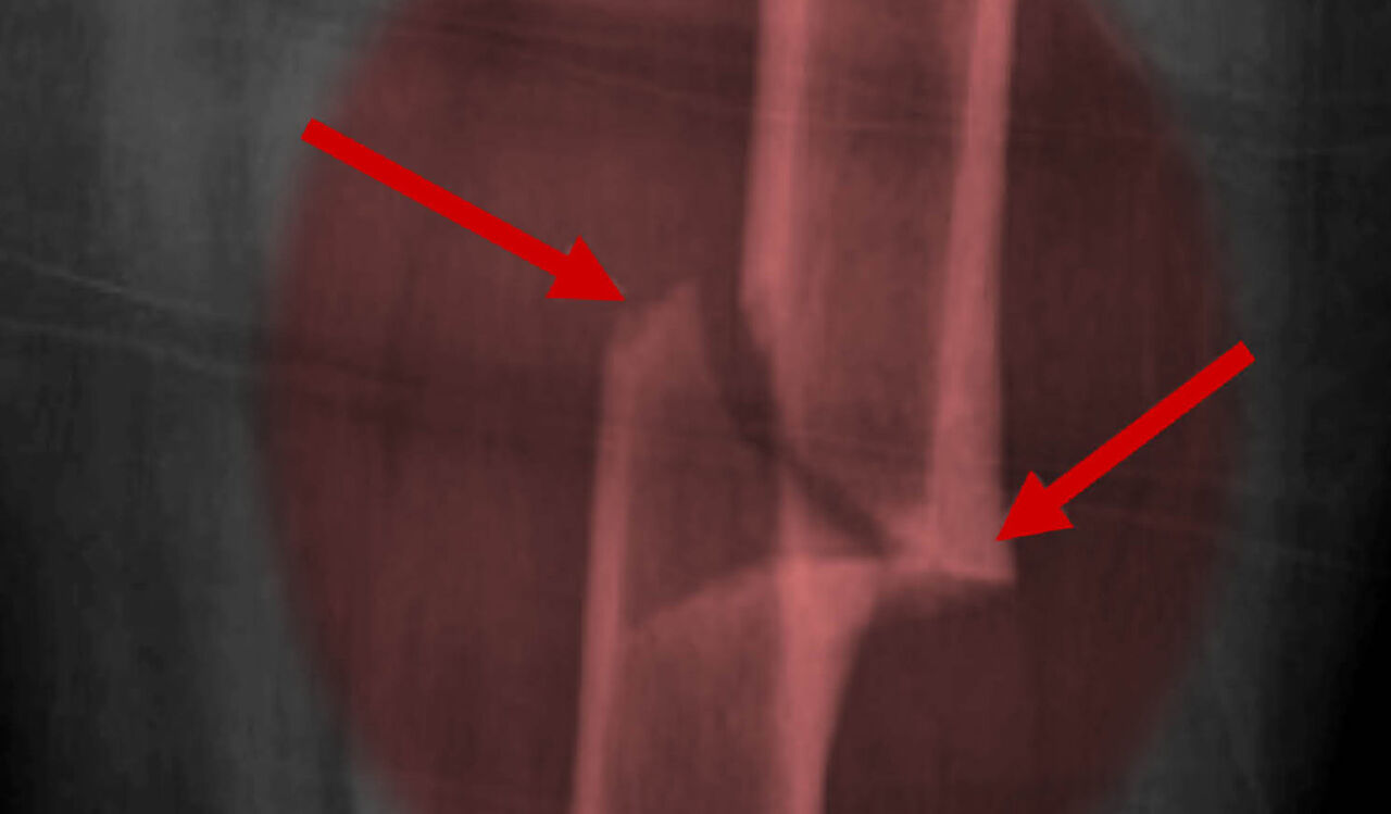 Röntgen-bild lårbensfraktur.