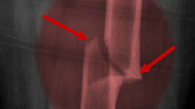 Röntgen-bild lårbensfraktur.